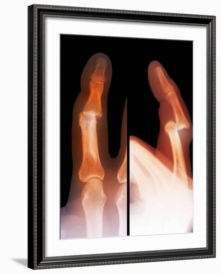 Dislocated Finger Joint, X-ray-ZEPHYR-Framed Photographic Print