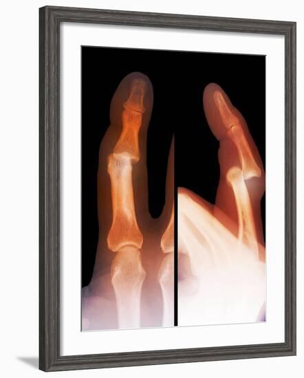 Dislocated Finger Joint, X-ray-ZEPHYR-Framed Photographic Print