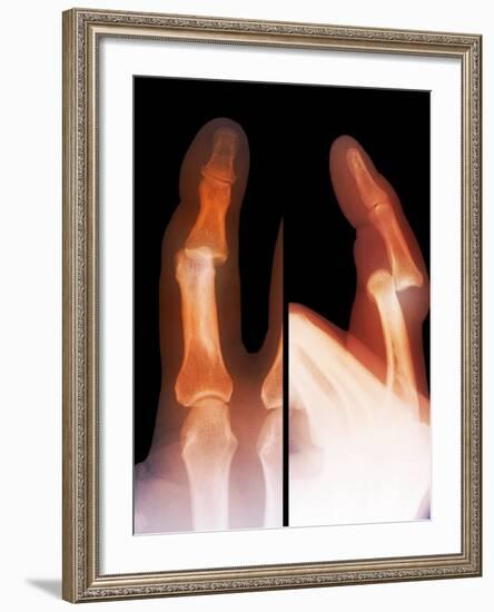 Dislocated Finger Joint, X-ray-ZEPHYR-Framed Photographic Print