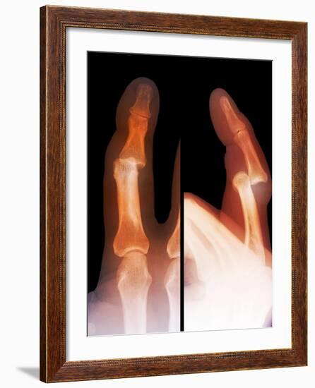 Dislocated Finger Joint, X-ray-ZEPHYR-Framed Photographic Print