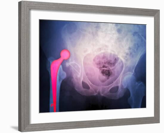 Dislocated Hip Prosthesis, X-ray'-Du Cane Medical-Framed Photographic Print