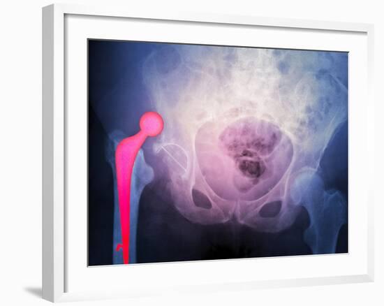 Dislocated Hip Prosthesis, X-ray'-Du Cane Medical-Framed Photographic Print