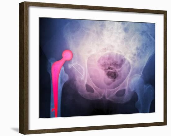 Dislocated Hip Prosthesis, X-ray'-Du Cane Medical-Framed Photographic Print