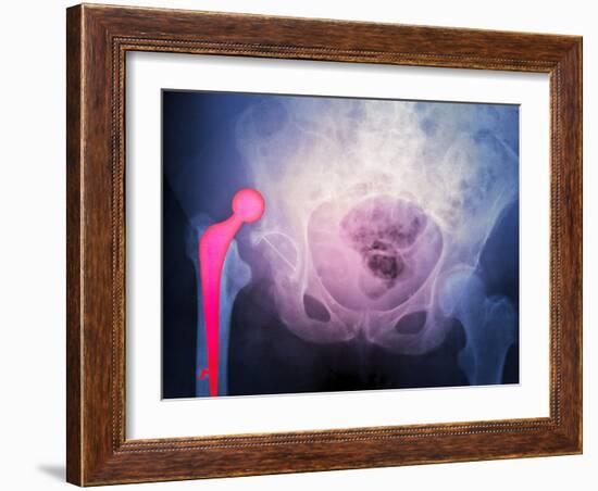 Dislocated Hip Prosthesis, X-ray'-Du Cane Medical-Framed Photographic Print