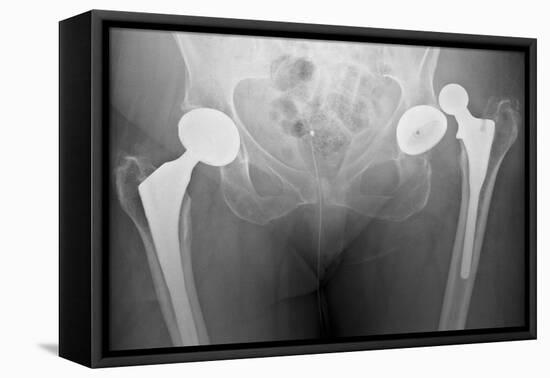 Dislocated Hip Replacement, X-ray-Du Cane Medical-Framed Premier Image Canvas
