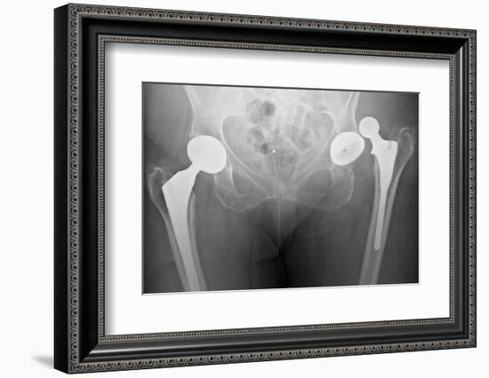 Dislocated Hip Replacement, X-ray-Du Cane Medical-Framed Photographic Print