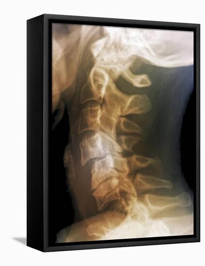 Dislocated Neck Bones, X-ray-ZEPHYR-Framed Premier Image Canvas
