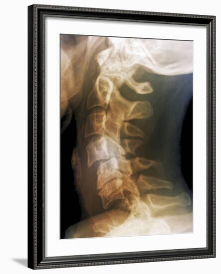 Dislocated Neck Bones, X-ray-ZEPHYR-Framed Photographic Print