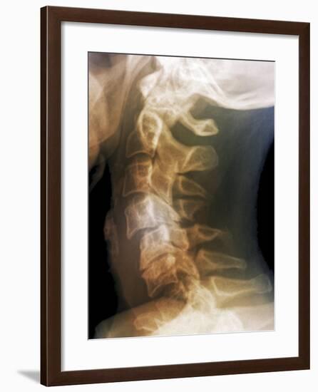 Dislocated Neck Bones, X-ray-ZEPHYR-Framed Photographic Print