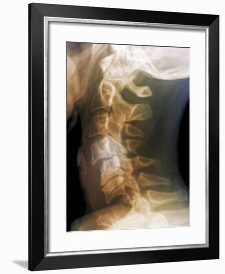 Dislocated Neck Bones, X-ray-ZEPHYR-Framed Photographic Print