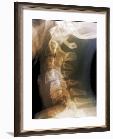 Dislocated Neck Bones, X-ray-ZEPHYR-Framed Photographic Print