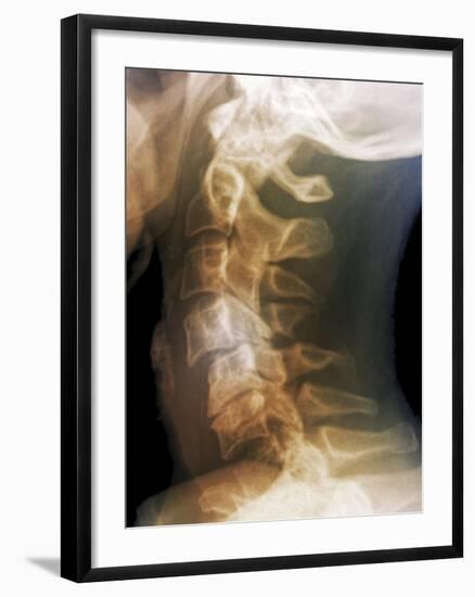 Dislocated Neck Bones, X-ray-ZEPHYR-Framed Photographic Print