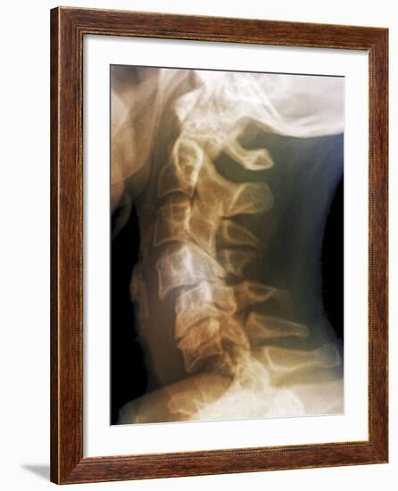 Dislocated Neck Bones, X-ray-ZEPHYR-Framed Photographic Print