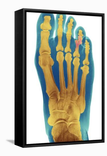 Dislocated Toe, X-ray-Du Cane Medical-Framed Premier Image Canvas