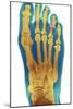 Dislocated Toe, X-ray-Du Cane Medical-Mounted Photographic Print