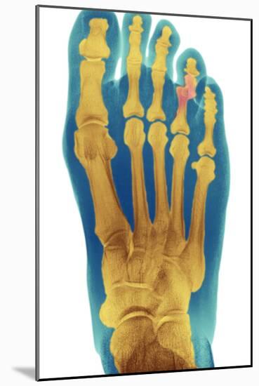 Dislocated Toe, X-ray-Du Cane Medical-Mounted Photographic Print