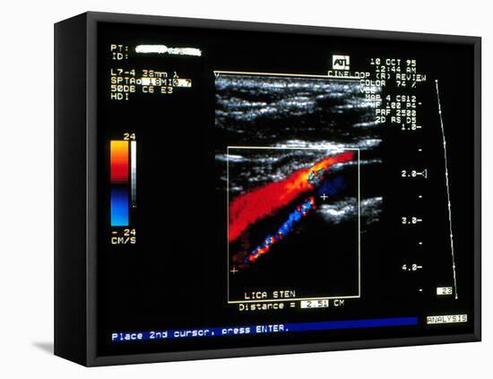 Doppler Ultrasound Scan of Carotid Artery Stenosis-Science Photo Library-Framed Premier Image Canvas