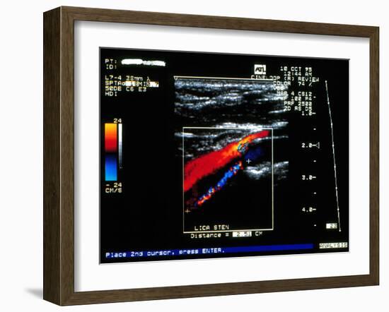 Doppler Ultrasound Scan of Carotid Artery Stenosis-Science Photo Library-Framed Photographic Print