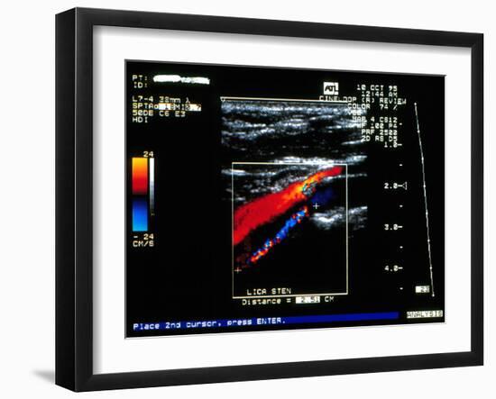 Doppler Ultrasound Scan of Carotid Artery Stenosis-Science Photo Library-Framed Photographic Print