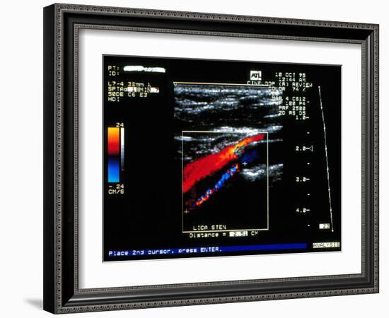 Doppler Ultrasound Scan of Carotid Artery Stenosis-Science Photo Library-Framed Photographic Print