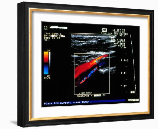 Doppler Ultrasound Scan of Carotid Artery Stenosis-Science Photo Library-Framed Photographic Print