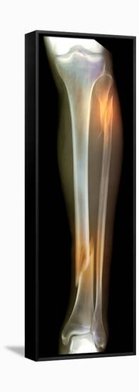 Double Fracture To the Leg, X-ray'-Du Cane Medical-Framed Premier Image Canvas