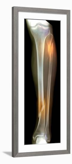 Double Fracture To the Leg, X-ray'-Du Cane Medical-Framed Photographic Print