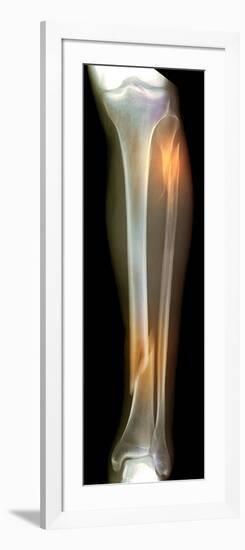 Double Fracture To the Leg, X-ray'-Du Cane Medical-Framed Photographic Print