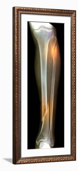 Double Fracture To the Leg, X-ray'-Du Cane Medical-Framed Photographic Print