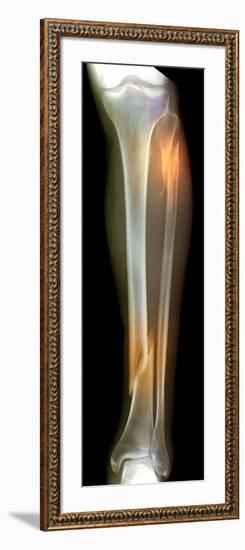 Double Fracture To the Leg, X-ray'-Du Cane Medical-Framed Photographic Print