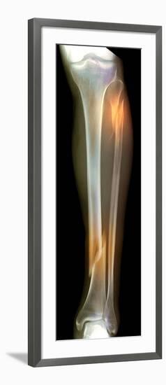 Double Fracture To the Leg, X-ray'-Du Cane Medical-Framed Photographic Print