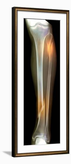 Double Fracture To the Leg, X-ray'-Du Cane Medical-Framed Photographic Print