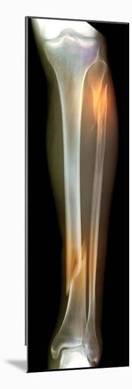 Double Fracture To the Leg, X-ray'-Du Cane Medical-Mounted Photographic Print