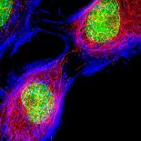 Cancer Cell Division-Dr. Paul Andrews-Premier Image Canvas