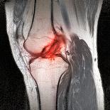 Anterior Cruciate Ligament Tear, CT Scan-Du Cane Medical-Premium Photographic Print