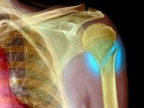 Broken Upper Arm Bone, X-ray-Du Cane Medical-Photographic Print