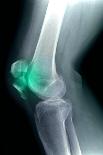 Broken Upper Arm Bone, X-ray-Du Cane Medical-Photographic Print