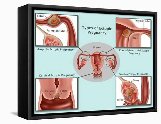 Ectopic Pregnancy-Gwen Shockey-Framed Premier Image Canvas