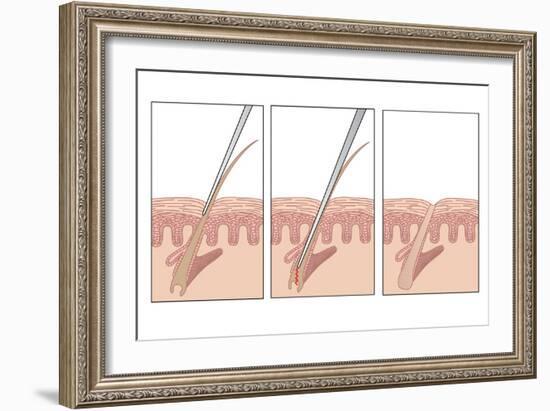 Electrolysis Hair Removal, Artwork-Peter Gardiner-Framed Photographic Print