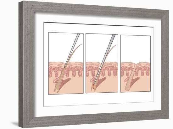 Electrolysis Hair Removal, Artwork-Peter Gardiner-Framed Photographic Print