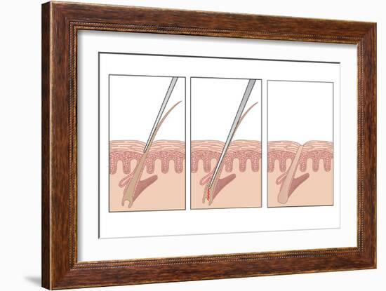 Electrolysis Hair Removal, Artwork-Peter Gardiner-Framed Photographic Print