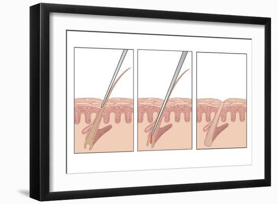 Electrolysis Hair Removal, Artwork-Peter Gardiner-Framed Photographic Print