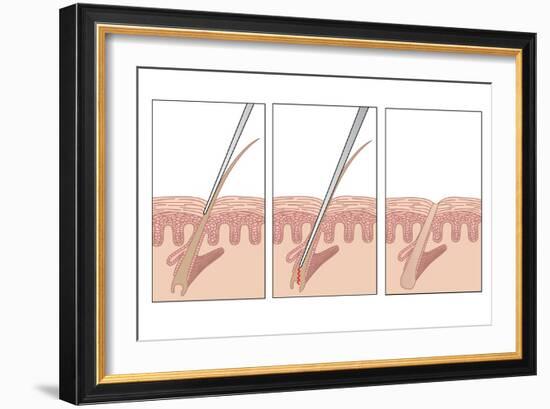 Electrolysis Hair Removal, Artwork-Peter Gardiner-Framed Photographic Print