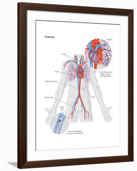 Embolism-Encyclopaedia Britannica-Framed Art Print