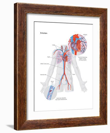 Embolism-Encyclopaedia Britannica-Framed Art Print