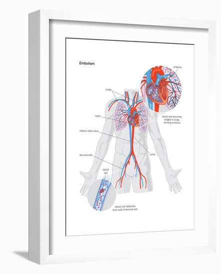 Embolism-Encyclopaedia Britannica-Framed Art Print