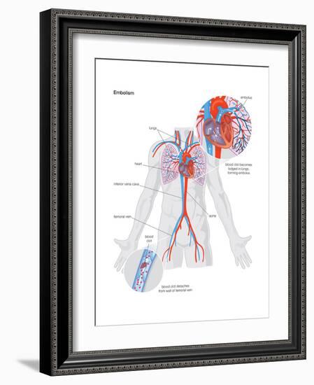 Embolism-Encyclopaedia Britannica-Framed Art Print