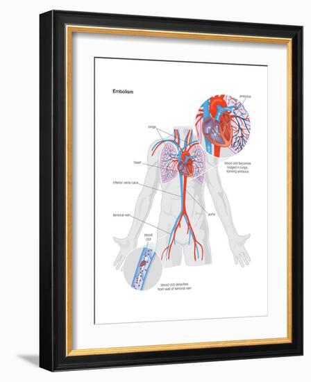 Embolism-Encyclopaedia Britannica-Framed Art Print