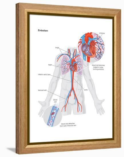 Embolism-Encyclopaedia Britannica-Framed Stretched Canvas