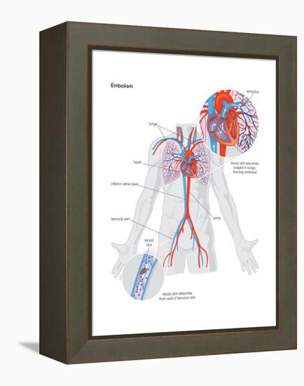 Embolism-Encyclopaedia Britannica-Framed Stretched Canvas